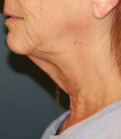 Feel Beautiful - Sagging Neck Lift - Before Photo